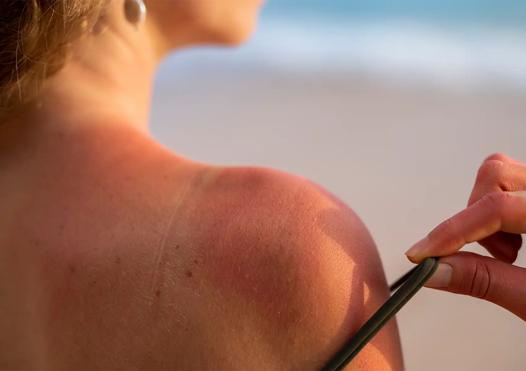 Close-up of a woman's sunburned shoulder being gently examined prior to a soothing after-sun treatment at the best spa in ubud.
